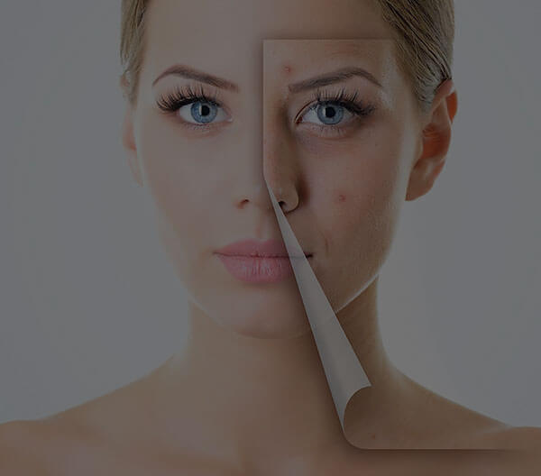 Laser Toning to Cure Melasma Acne Scars Sun Spots & more