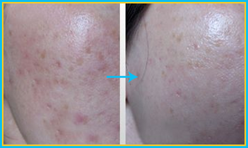 Microdermabrasion Treatment for Acne & Acne Scars in Hyderabad