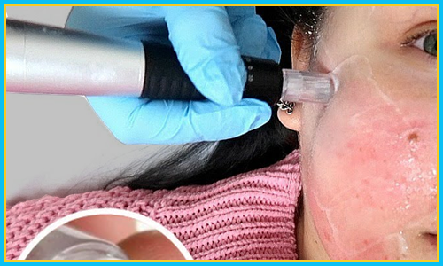 Microneedling Treatment for Acne & Acne Scars in Hyderabad