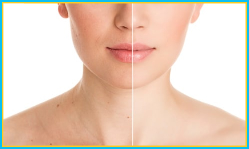 Rejuvenate Your Skin with Laser Hair removal Treatment in Hyderabad