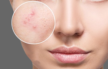 What Is Acne? What are The Causes Symptoms of Acne?